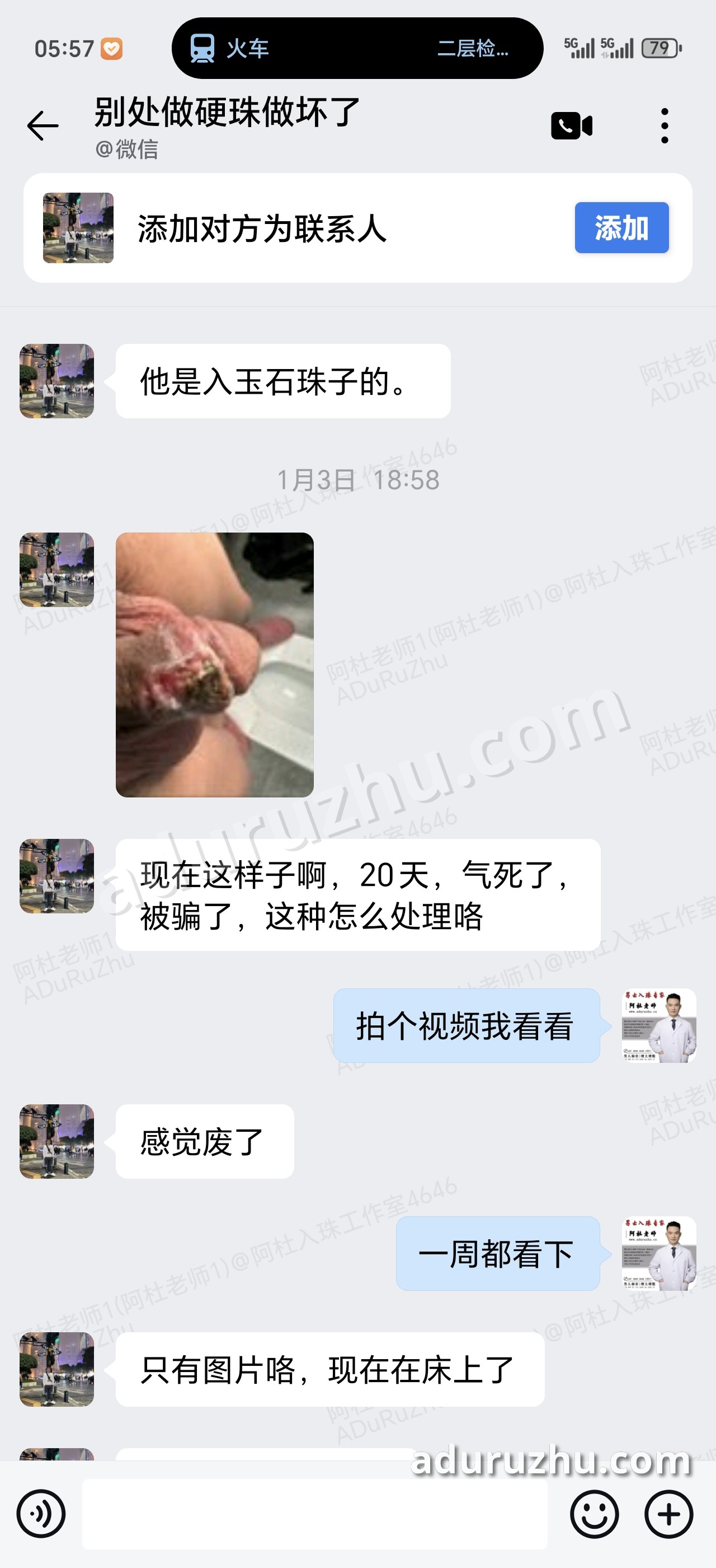 别处做的玉石硬珠,20 天筋膜溃烂