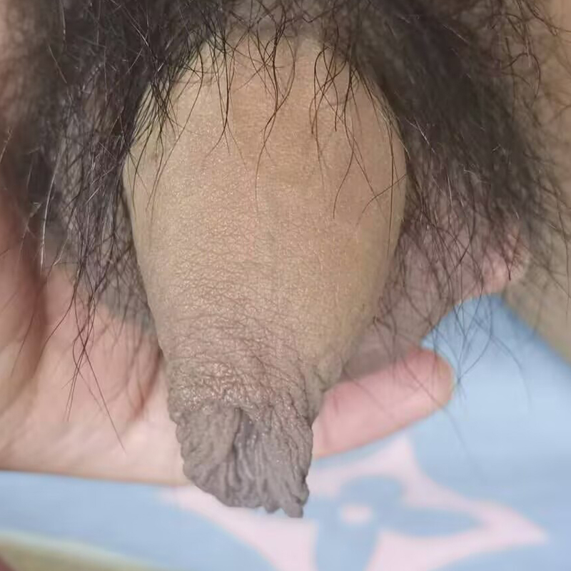 包皮过长入珠效果（前后对比）
